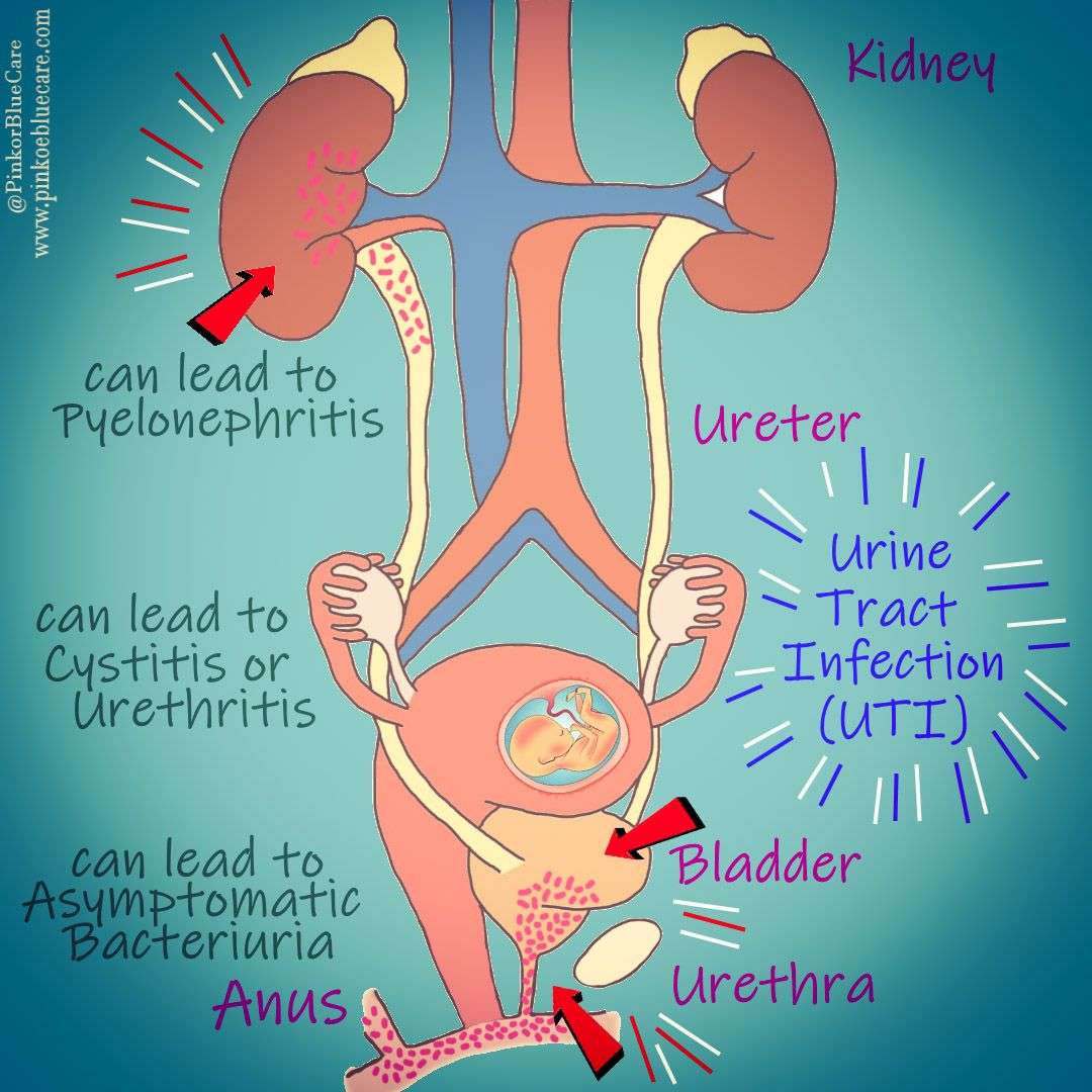 Kidney Infection In Pregnancy