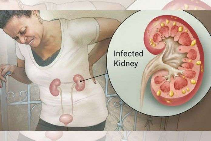 Kidney Infection Symptoms to check