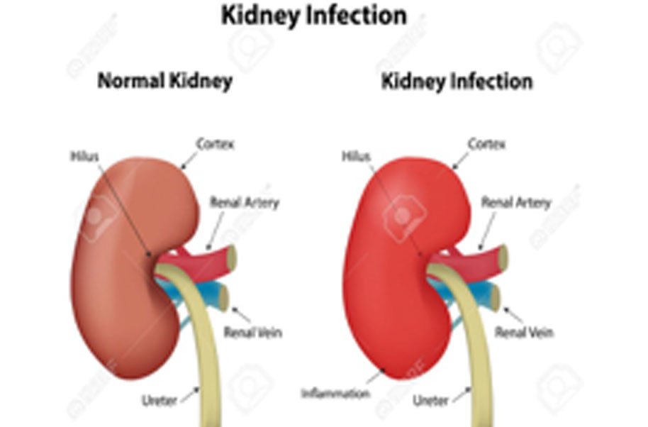 Kidney Infection (Upper Urinary Tract Infection)