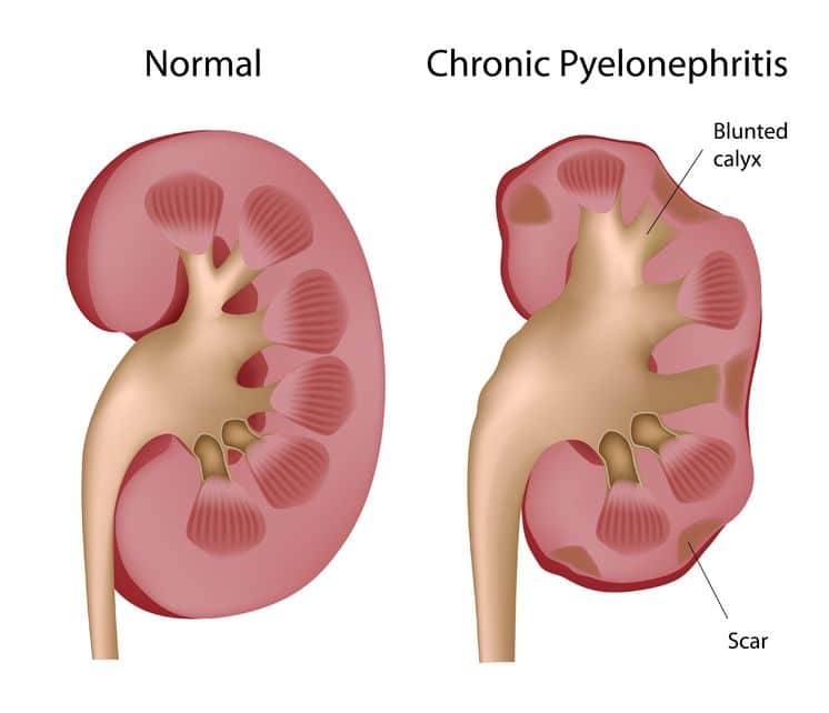 Kidney Infections: Sign Symptoms and Treatments