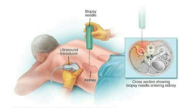 Kidney, Liver and Bone Marrow Biopsy