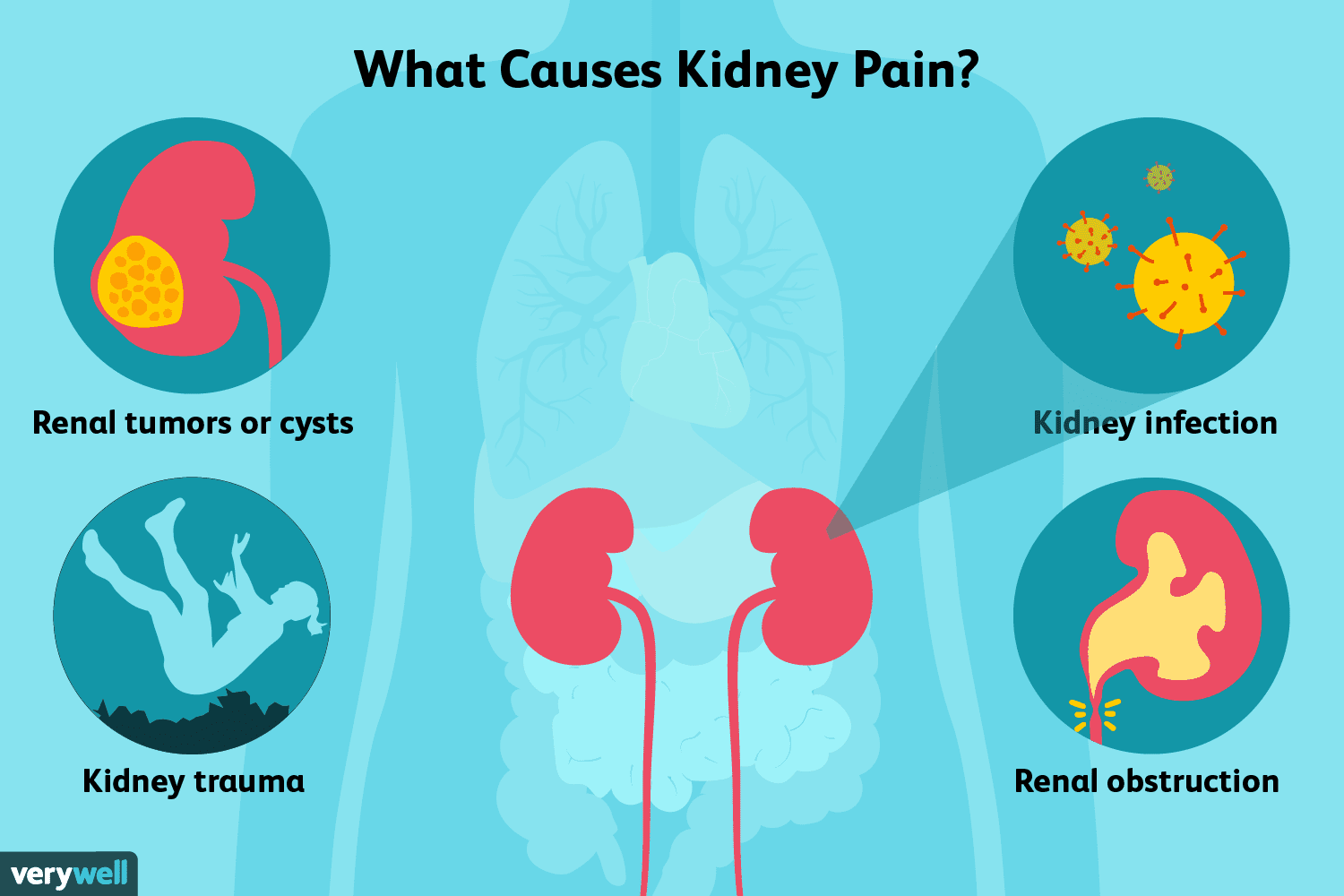 Kidney Pain: Causes, Treatment, and When to See a Doctor