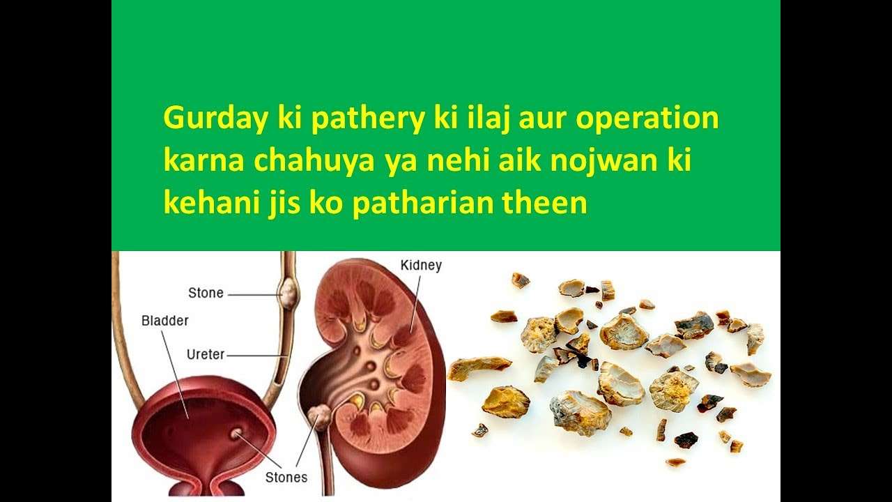 Kidney stone causes and treatment in urdu