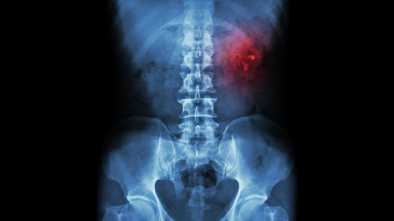 Kidney Stone In X Ray