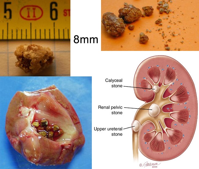 Kidney Stone Left Ureter Pain Location