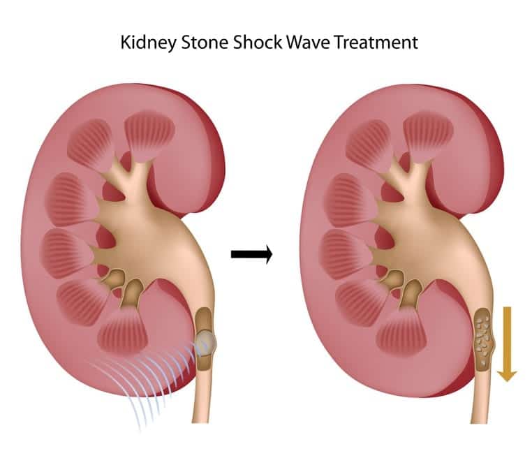 Kidney Stone Lithotripsy
