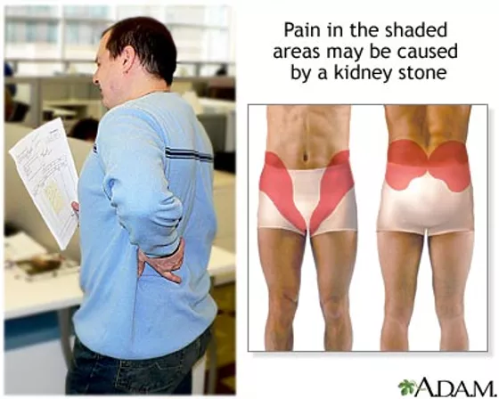 Kidney Stone Pain Or Pulled Muscle