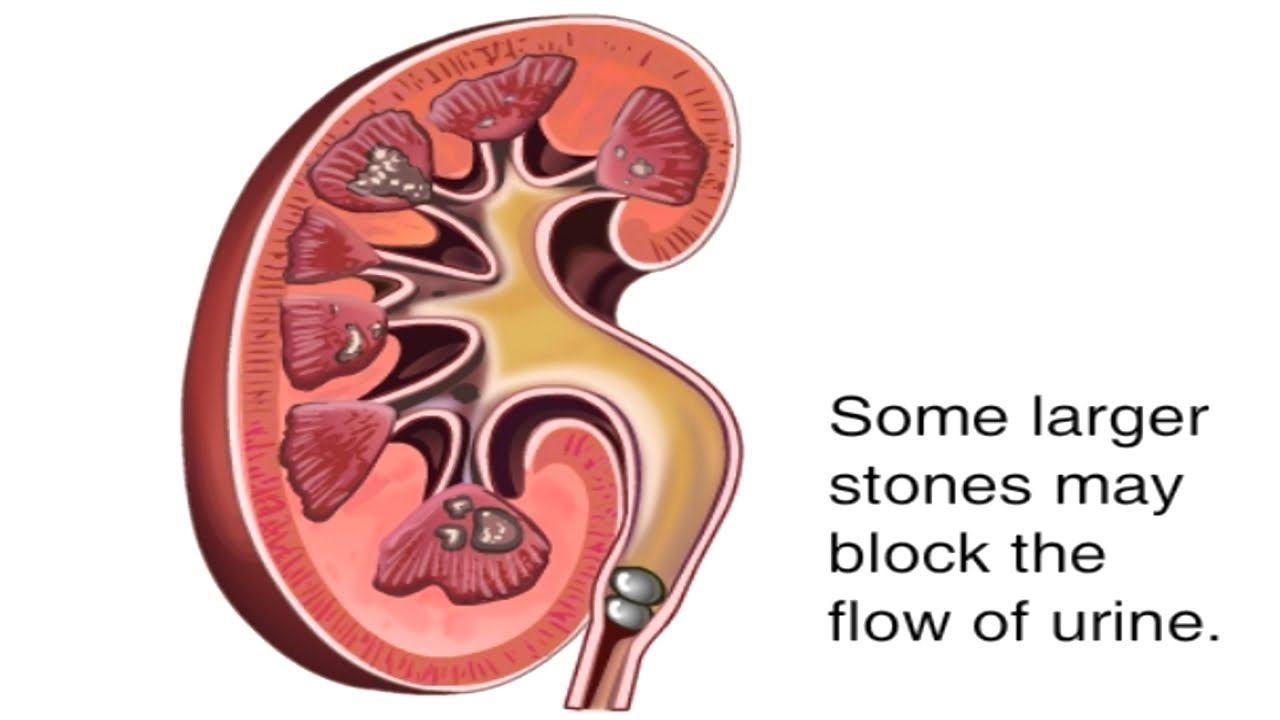 Kidney Stone Passing Through Urine Video