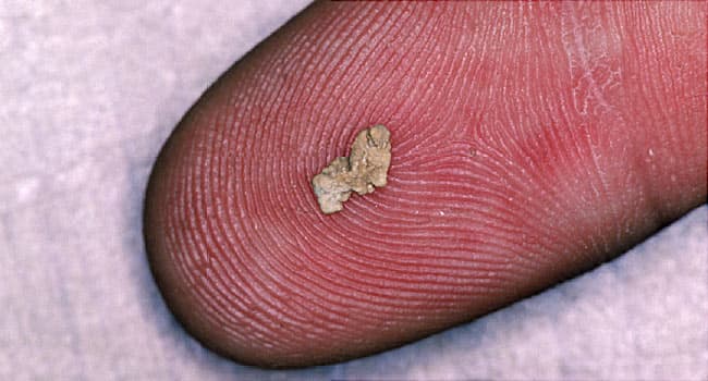 Kidney Stone Pictures: Symptoms, Causes, Treatments, and ...
