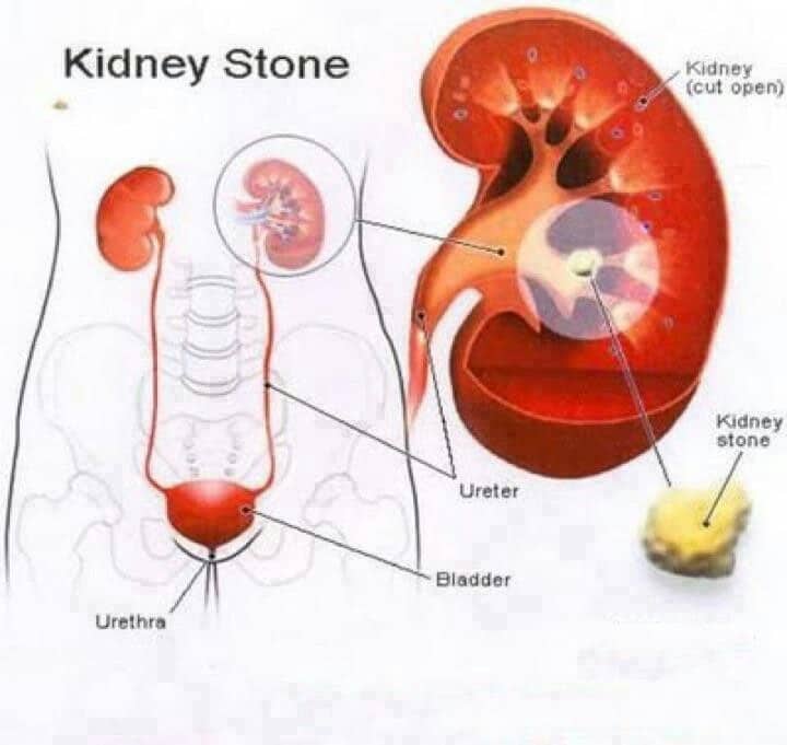 Kidney stone remedy