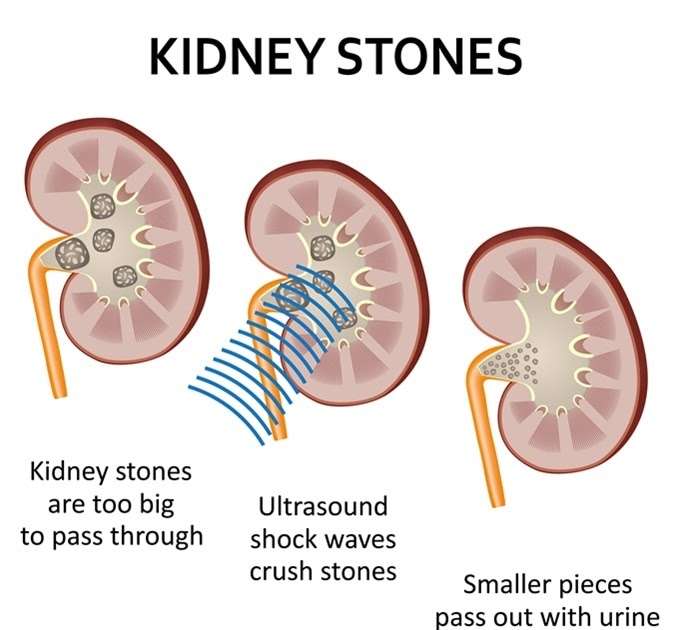 Kidney Stone Removal Surgery Options