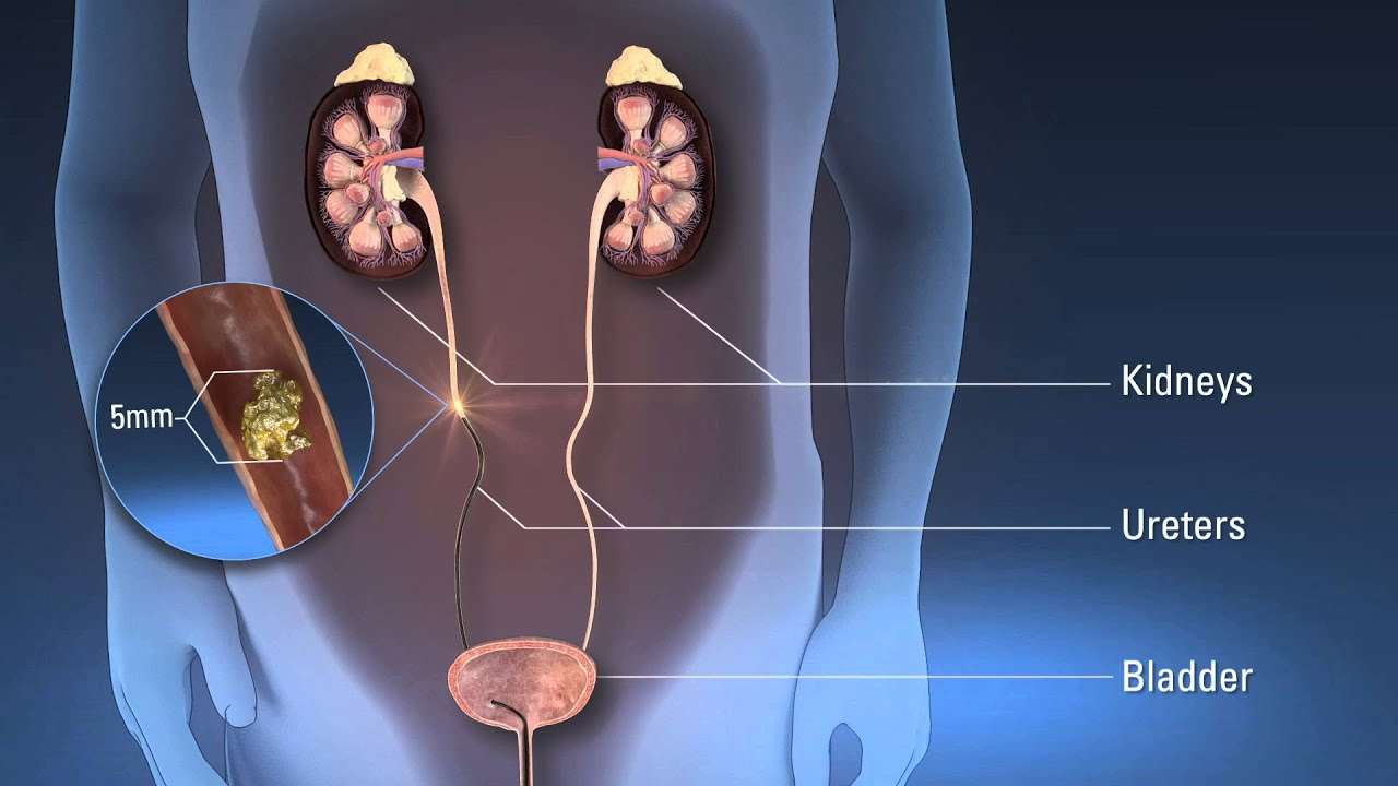 Kidney Stone Removal Ureteroscopy Male