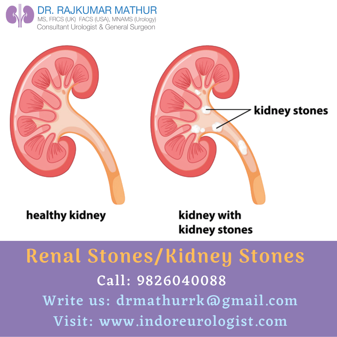 Kidney Stone Specialist Doctor Called