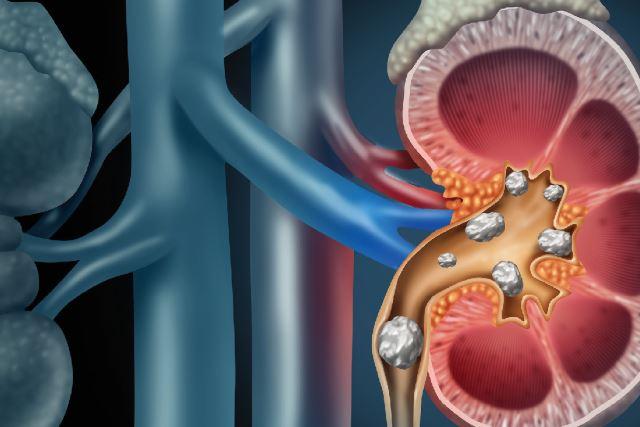 Diarrhea After Kidney Stone Surgery