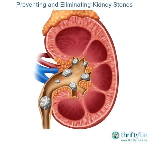 is-kidney-stone-operation-dangerous-healthykidneyclub