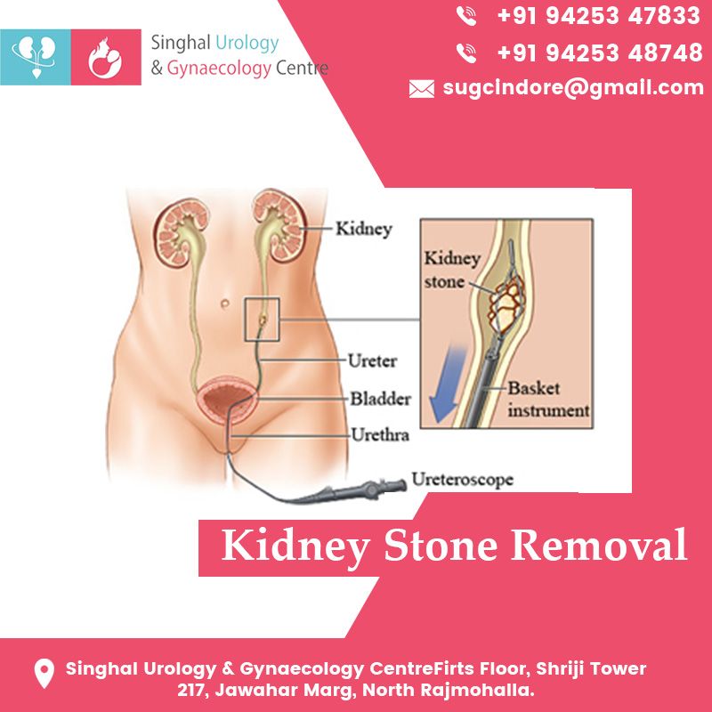Kidney Stone Surgery Recovery Time Answers