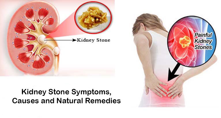 Kidney Stone Symptoms, Causes and Natural Remedies