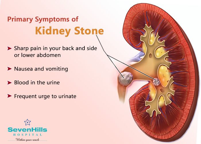 Kidney Stone Symptoms Last How Long