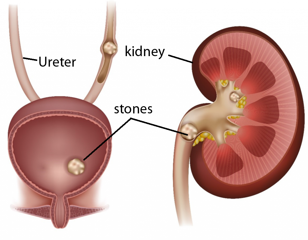 kidney stone: symptoms, risk factors, types, causes,