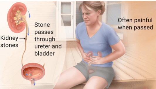 Kidney Stone Treatment in Chattanooga, TN