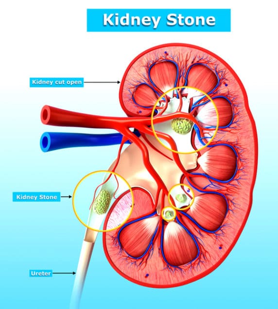 Kidney Stone Treatment: It Can Range from Home Remedies to Hospital ...