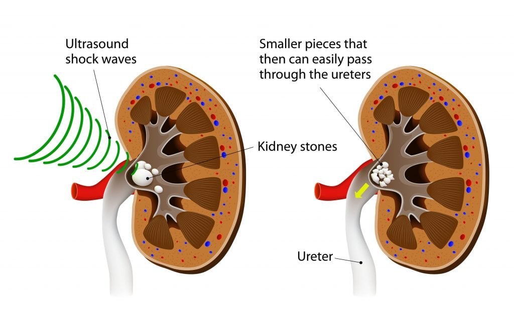 how-they-break-up-kidney-stones-healthykidneyclub