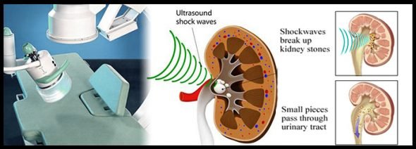 Kidney Stone Ultrasound Break Up