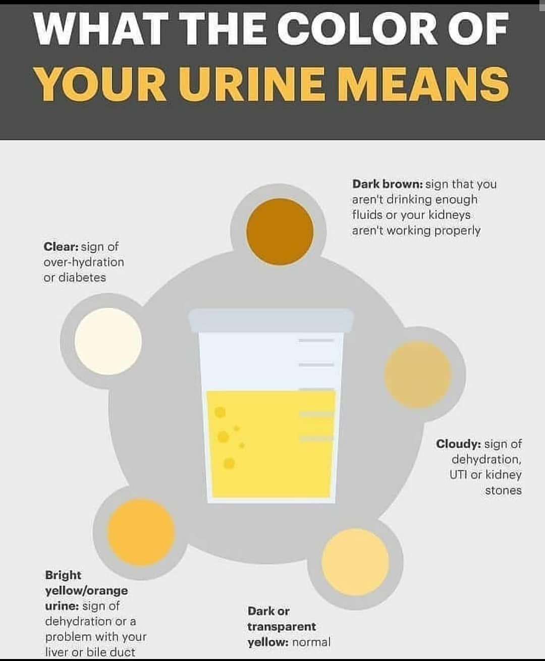 Kidney Stone Urine Color