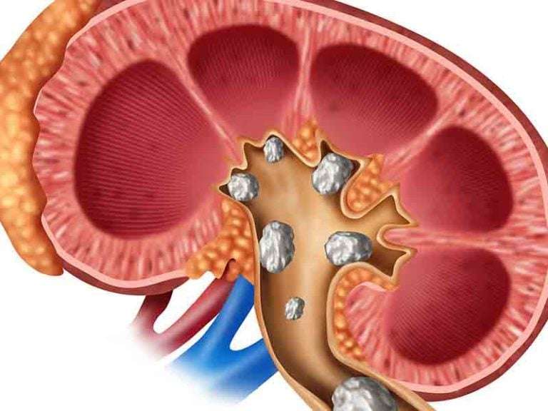 Kidney Stones â Ayurgem Ayurveda Treatment, Kerala