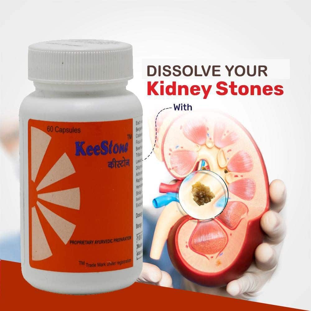 Can Calcium Supplements Cause Kidney Stones