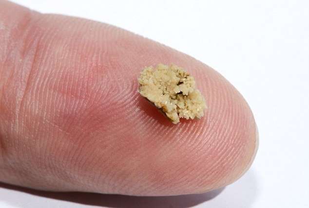 Kidney stones can be elimianted naturally
