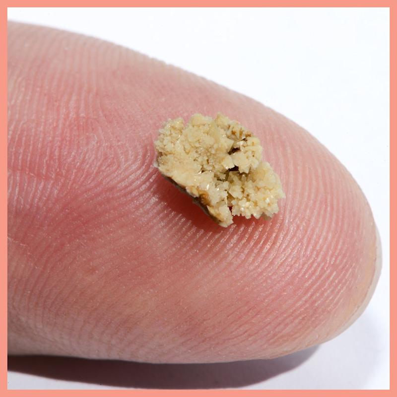 Kidney Stones Can Literally Make You Vomit From Pain
