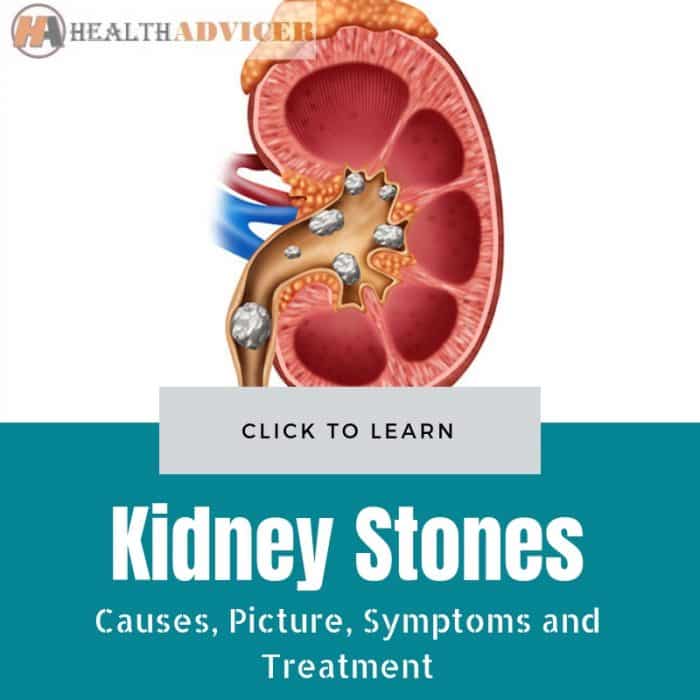 Kidney Stones: Causes, Picture, Symptoms And Treatment