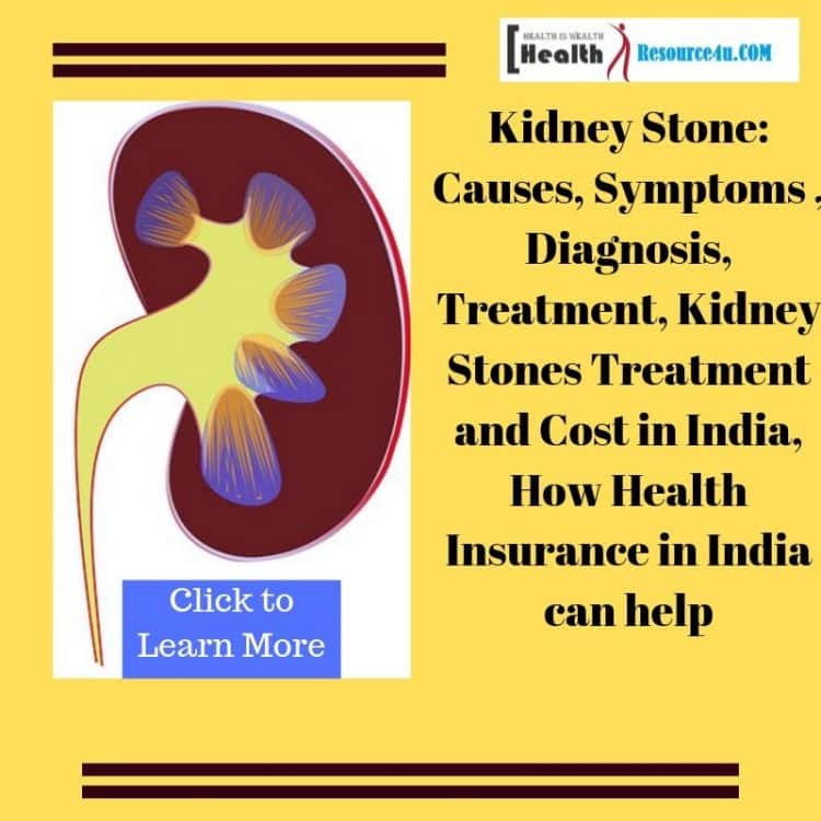 Kidney Stones: Causes, Symptoms, Treatment Cost, Health Insurance