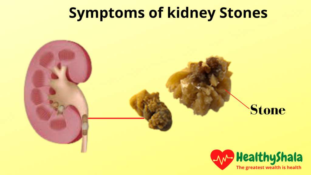 Kidney Stones: Causes, Symptoms, Types, And Treatment
