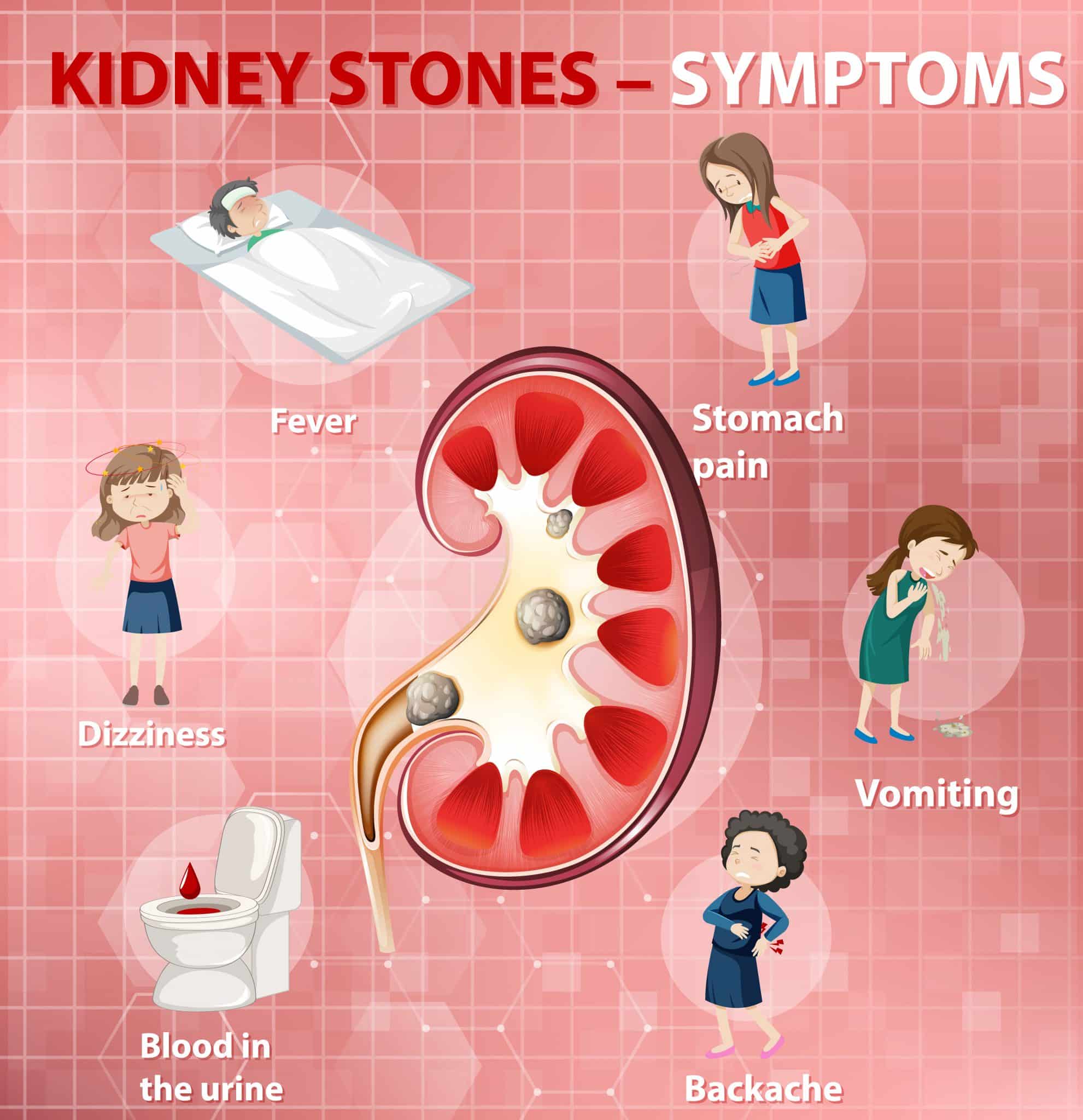 Kidney Stones: Causes, Symptoms, Types, &  Treatment