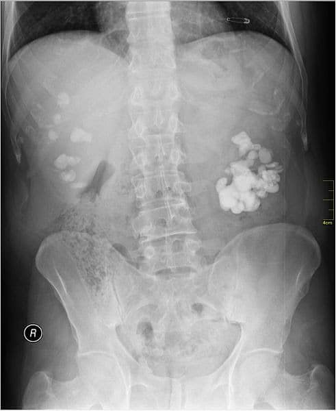 Kidney Stones Dog X Ray