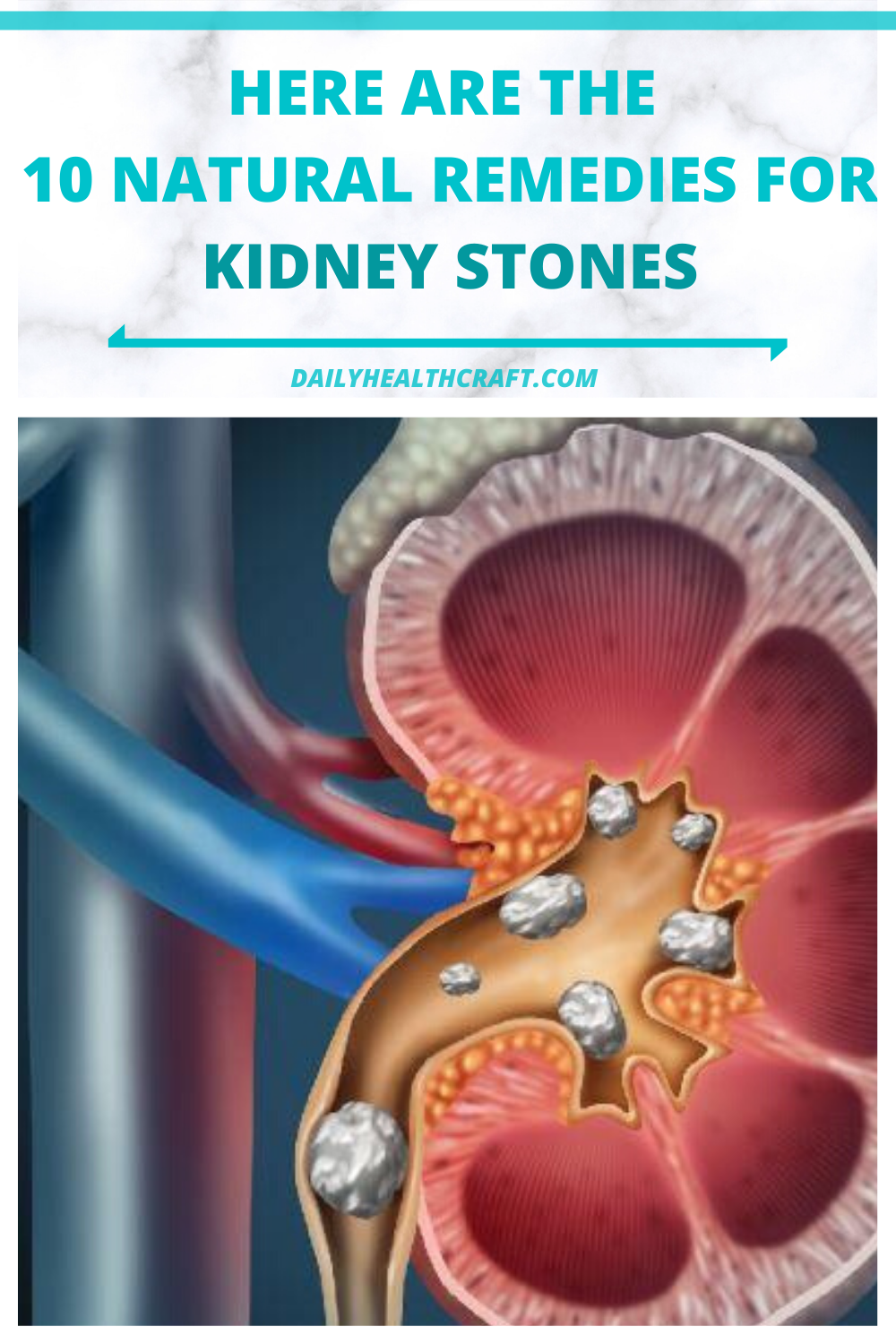 Kidney Stones Feel Like Labor