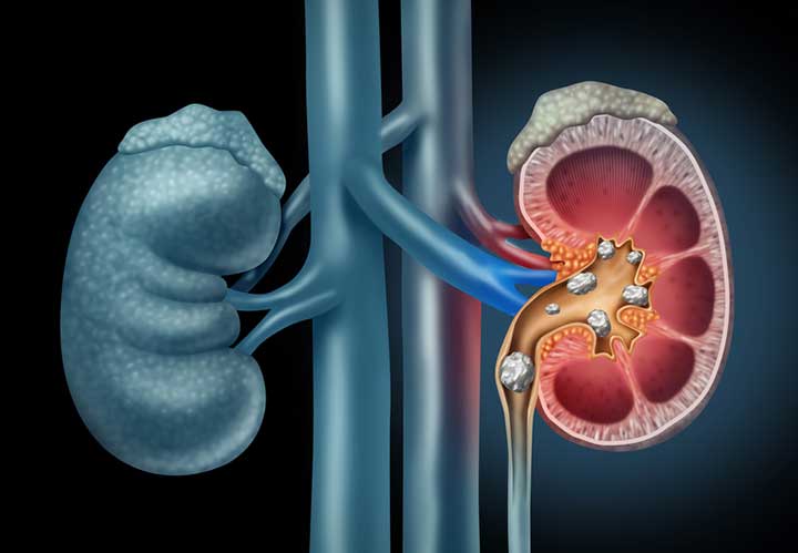 Kidney Stones: How to Manage the Pain and Discomfort