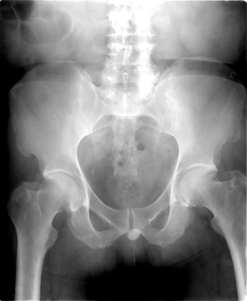 Kidney Stones In Bladder X Ray