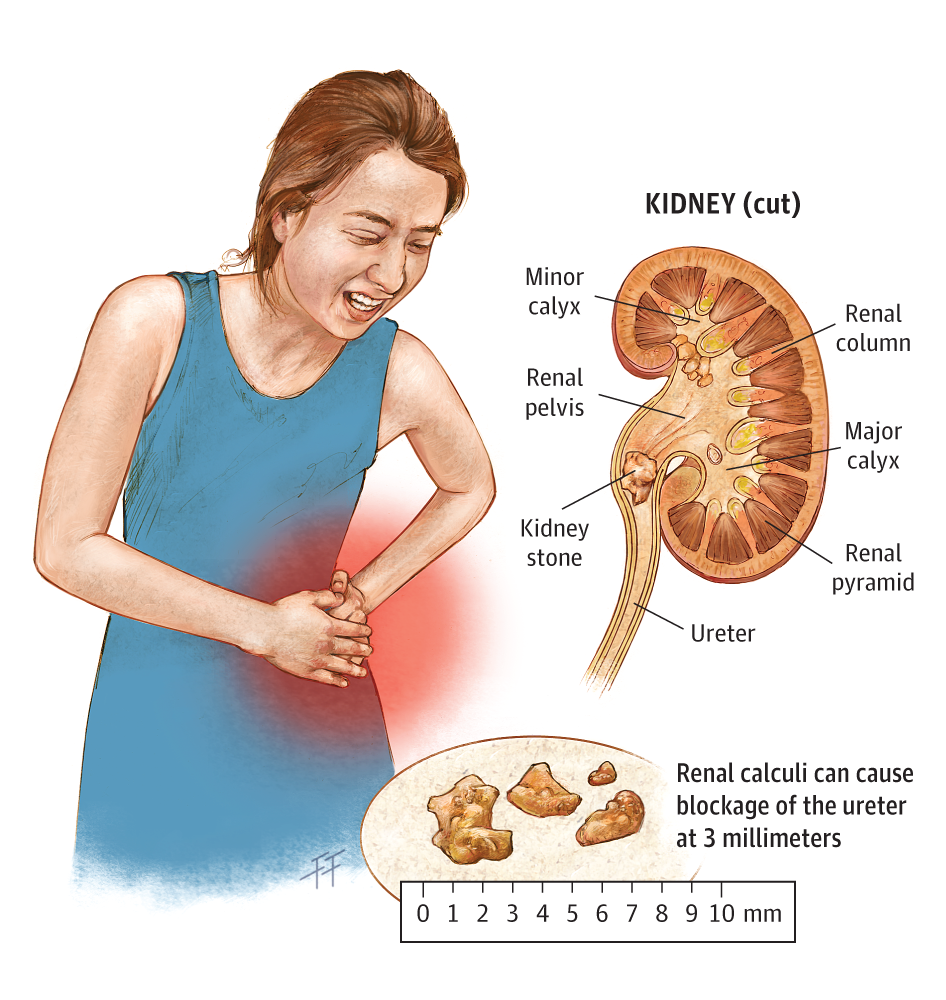 What Does Kidney Stones Feel Like Symptoms HealthyKidneyClub