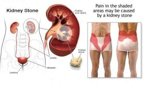 Kidney Stones Make You Feel Full