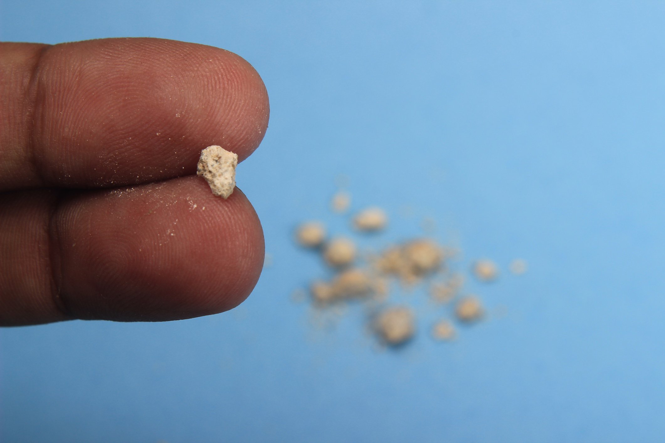 Kidney Stones: More Common Than You May Think
