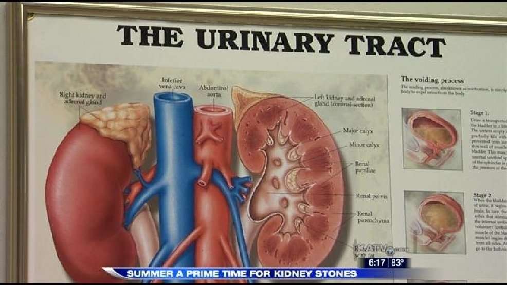 Kidney stones more prevalent in southern men