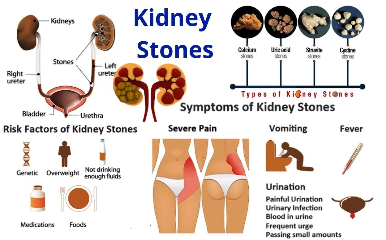 Kidney stones Online Homeopathic Treatment India Removed ...