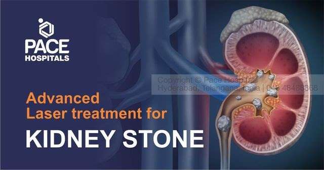 Kidney Stones Operation Recovery Time