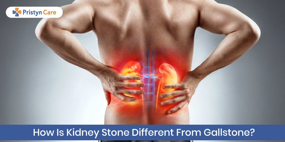Kidney Stones Pass Through Urine Or Stool