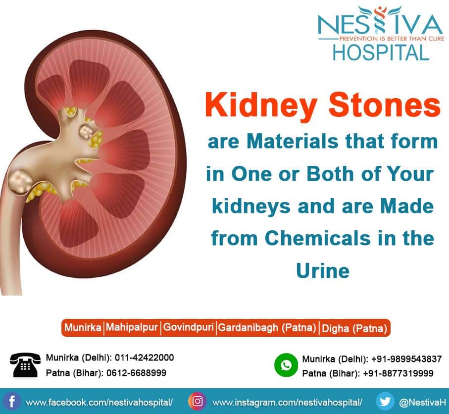 Kidney Stones Removal Medical Term
