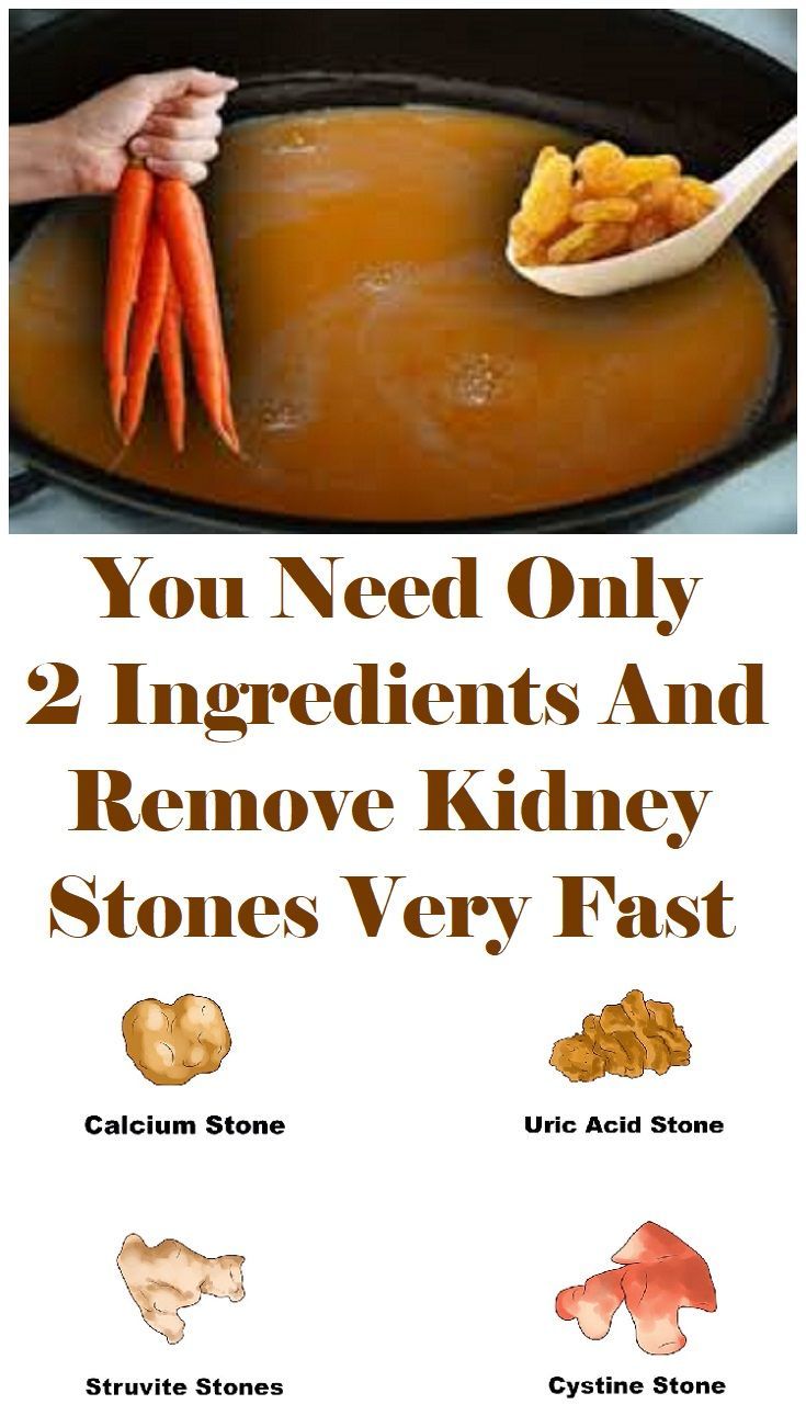 Kidney Stones Remove Exercise