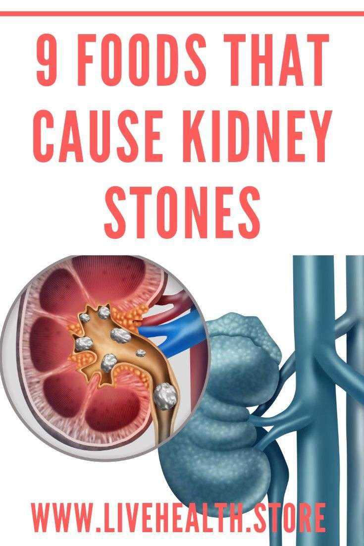 Kidney Stones Signs And Symptoms Tagalog